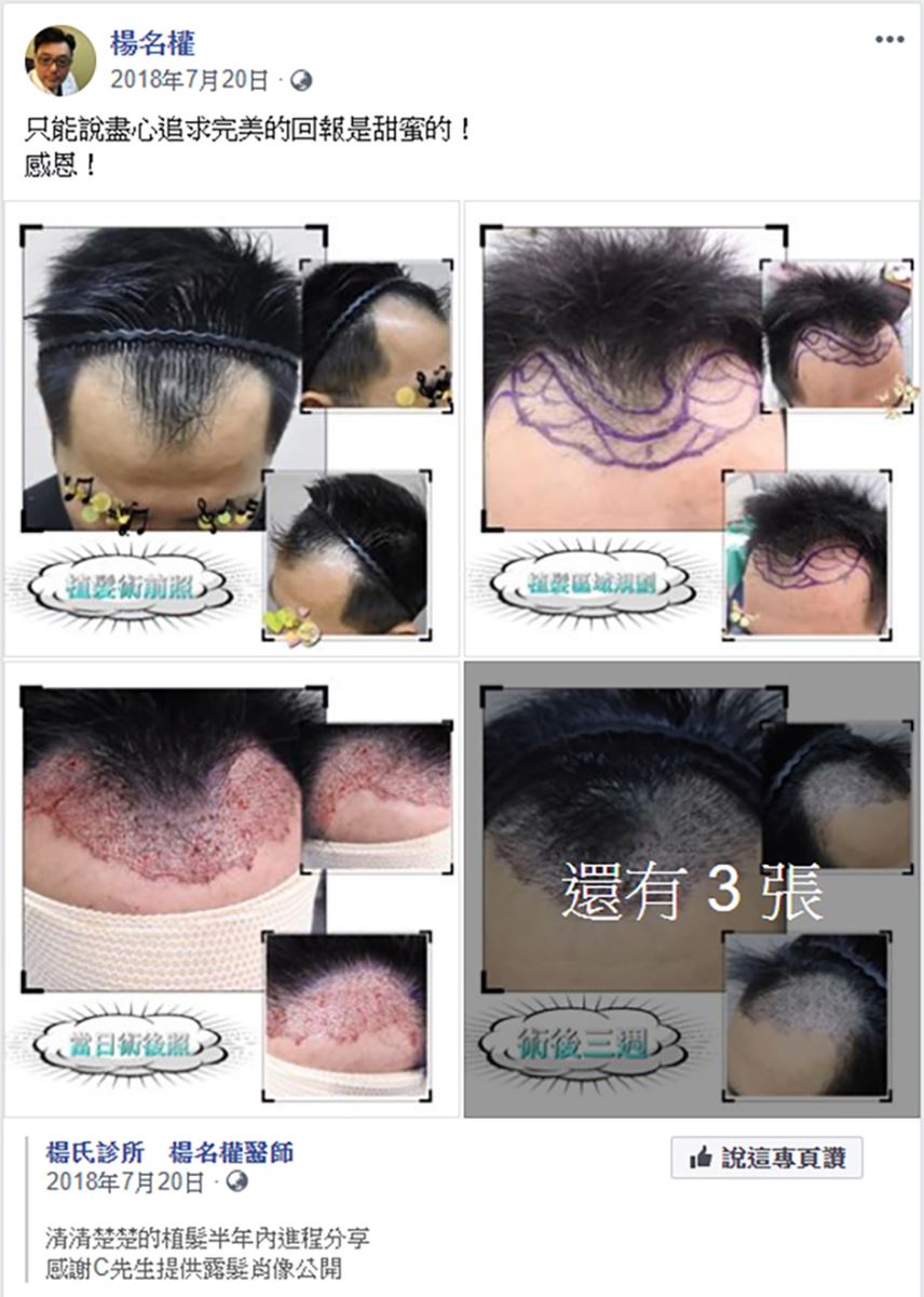 植髮,禿頭,雄性禿,楊氏羅丹